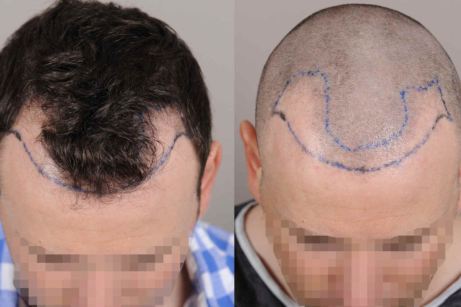 Methoden Der Haartransplantation Fue Und Fut Technik Im Uberblick