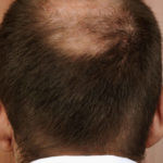 Haartransplantation Spenderbereich