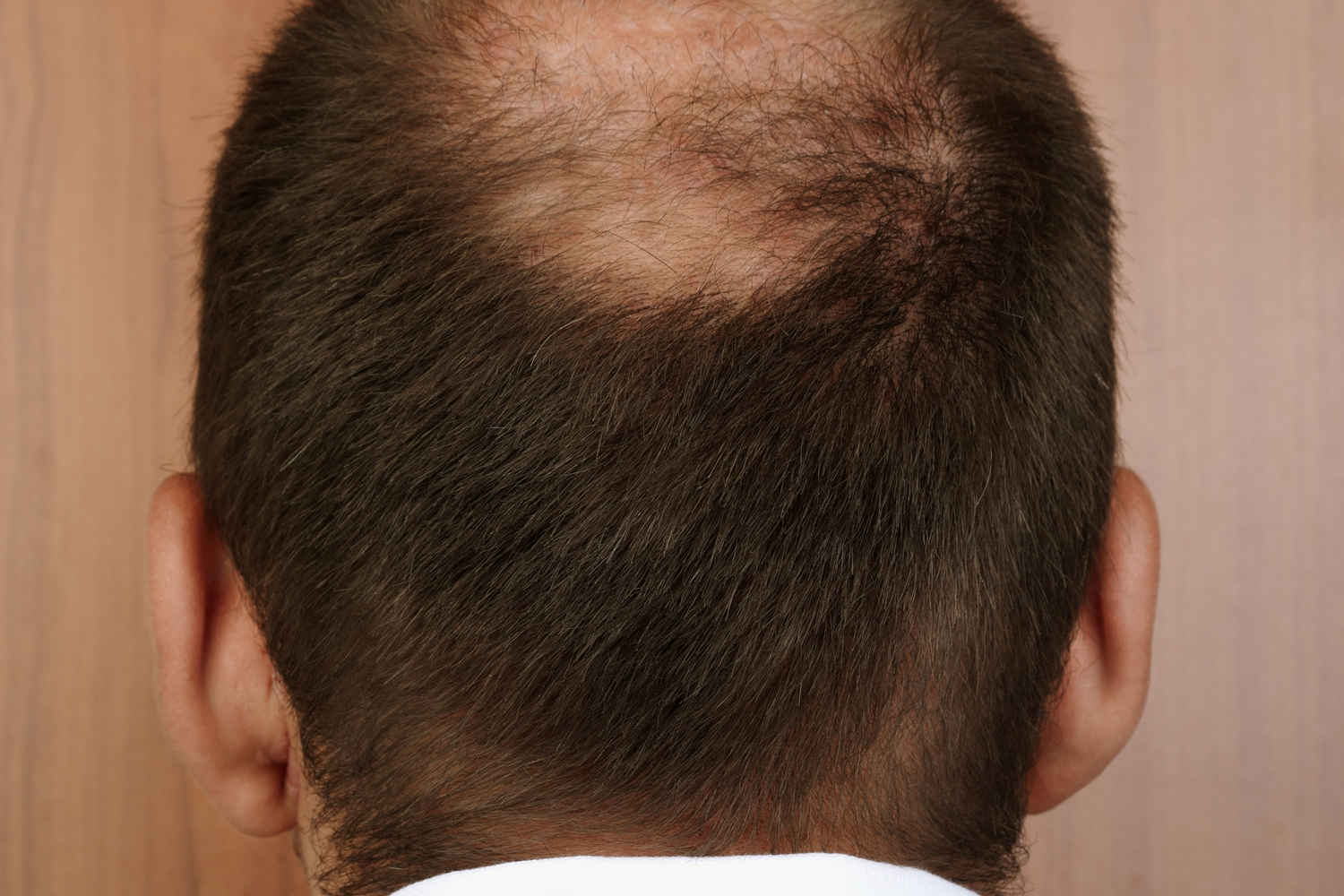 Haartransplantation & Spenderbereich: So erholt sich der Hinterkopf schneller